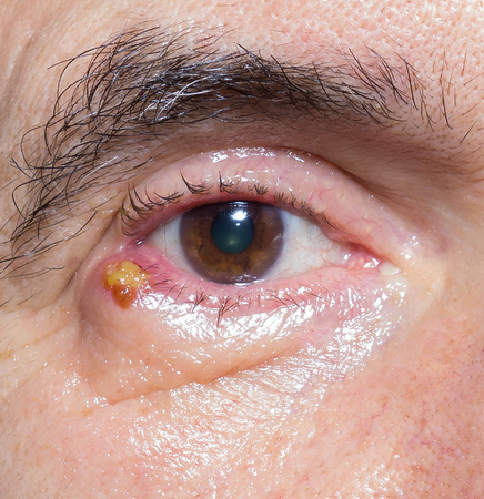 close up of chalazion during ophthalmic examination.の写真素材