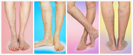The female legs with veins varicose spider. Collage