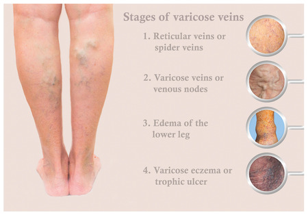 Varicose veins on a female senior legの写真素材