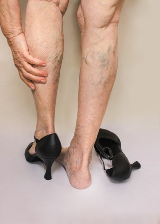 Painful varicose and spider veins on female legs.Woman in heels massaging tired legsの写真素材