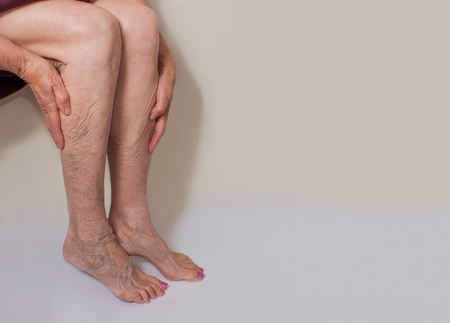 Varicose veins on a female legsの写真素材
