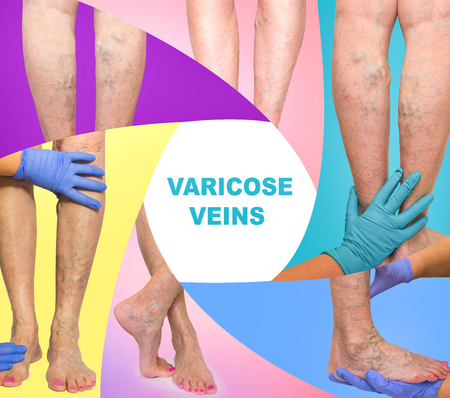 The female legs with veins varicose spider at studio. Collage. Lower limb vascular examination because suspect of venous insufficiency. The female legs on colored background. Varicose veins conceptの写真素材