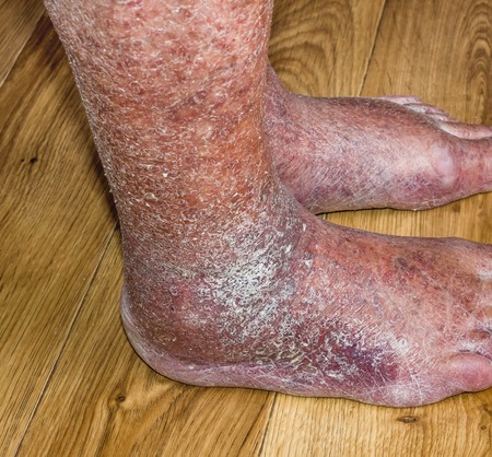 Close-up of skin with varicose veins on senior male leg. Concept of dry skin, old senior people,...