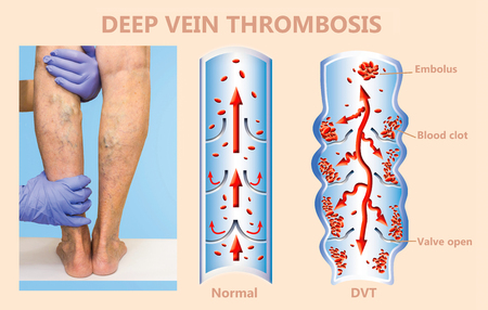 Deep Vein Thrombosis or Blood Clots. Embolus. Structure of normal and varicose female veins