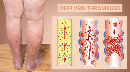 Deep Vein Thrombosis or Blood Clots. Embolus. Structure of normal and varicose male veinsの写真素材