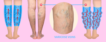 Varicose veins on a female senior legs. The structure of normal and varicose veins.の写真素材