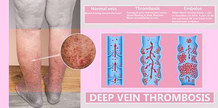 Deep Vein Thrombosis or Blood Clots. Embolus. Structure of normal and varicose male veinsの写真素材