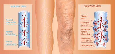 Varicose veins on a female senior legs. The structure of normal and varicose veins.の写真素材