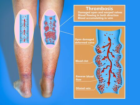 Deep Vein Thrombosis or Blood Clots. Embolus.の写真素材