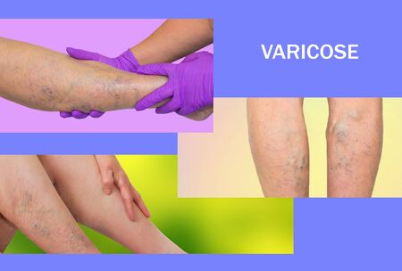The varicose veins on a legs of old woman on blueの写真素材