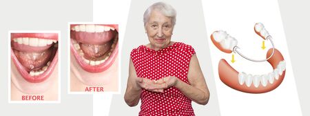 Dental rehabilitation with lower flexible nylon denture, before and after treatment. Removable...