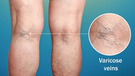 The old age and sick of a woman. Varicose veins on a legs of woman. The varicosity, spider veins, edema, illness concept.の写真素材