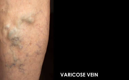 The old age and sick of a woman. Varicose veins on a legs of old woman on blue. The varicosity, spider veins, edema, illness concept. Senior pensioner woman with hands on legs.の写真素材