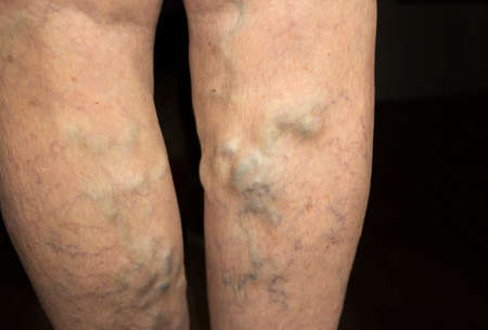 The old age and sick of a woman. Varicose veins on a legs of old woman on blue. The varicosity,...