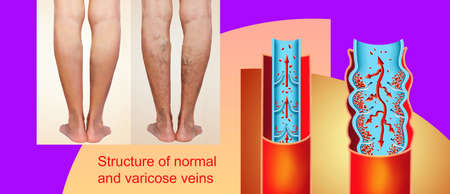 The old age and sick of a woman. Varicose veins on a legs of woman. The varicosity, spider veins, edema, illness concept.の写真素材