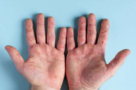 Painful rash, red spots blisters on the hand. Close up Allergy rash, human hands with dermatitis and Health problem. Ill eczema skin of patient. Viral Diseases. Red rashes on the palm. Enterovirusの写真素材