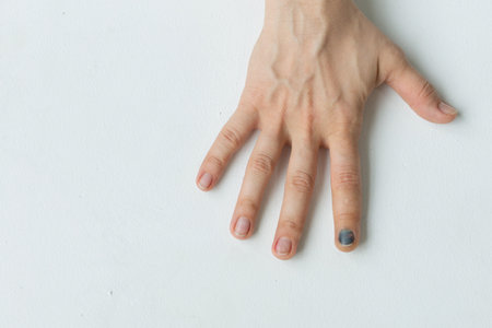 Hematoma on the index finger of a woman's hand, formed as a result of a fracture of the first phalanx of the finger.の写真素材
