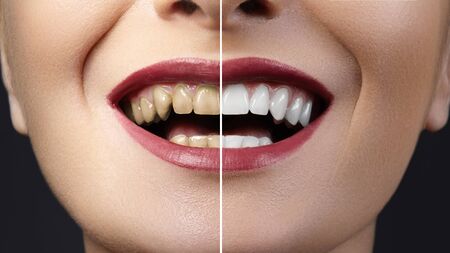 Close-up photo before and after whitening treatment or dental veneers procedure on teeth. Health Care collage of human mouth. Caries therapyの写真素材