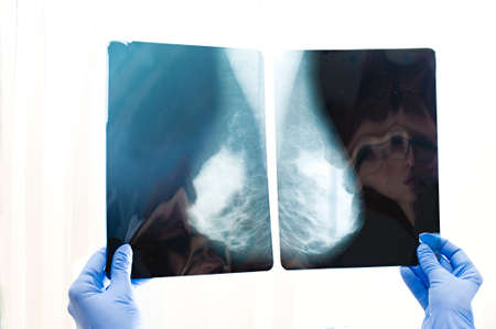 The doctor holds a picture of the mammary glands in his hands. Hardware examination of the breast.の写真素材
