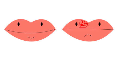 lips closeup with cold herpes, sore on the lip, vector illustrationのイラスト素材