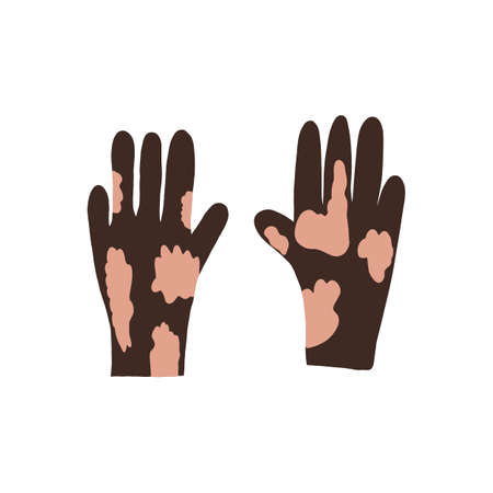 Flat vector cartoon illustration of hands with vitiligo. World vitiligo day. Skin diseases, pigmentation disorders.のイラスト素材