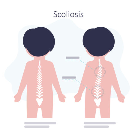 Educational poster with schoolboy have scoliosis problems. Child with disorders of the musculoskeletal system. Example of strong scoliosis. Spinal curve concept. Back view. vector illustrationのイラスト素材