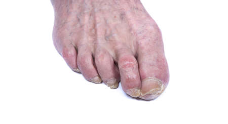 Sick nails on foot. Toenail fungus isolated on white. Sore toe-nail, nail fungus