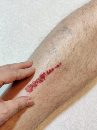 Examination of patient's shin with large abrasion. Mechanical damage to skin on man's leg. Wound...