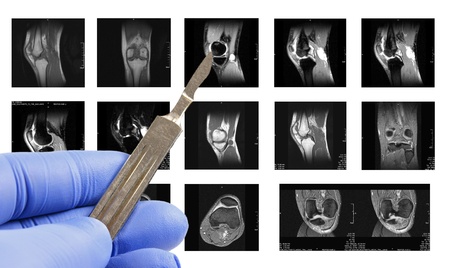 MRI images - Kneeの写真素材