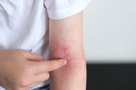 The child scratches atopic skin. Dermatitis, diathesis, allergy on the child's body.の写真素材