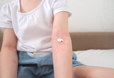 The child scratches atopic skin. The child applies a special cream to atopic skin. Dermatitis, diathesis, allergy on the child's body.の写真素材
