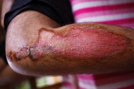 Physical human injury wound medicine healthcare. macroの写真素材
