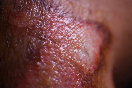 Physical human injury wound medicine healthcare. macroの写真素材