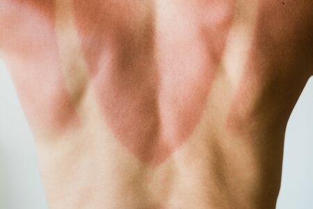 Close-up of a sunburn marks on a woman's backの写真素材