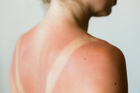 Close-up of a sunburn marks on a woman's backの写真素材