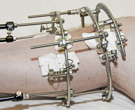 Broken Legの写真素材