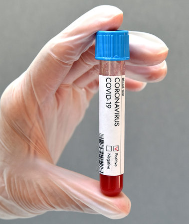 Coronavirus positive test result blood sample. Close-up