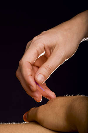 Male patient receiving acupuncture treatment to his handの写真素材