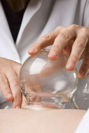 Close-up of vacuum cupping treatment applied to patients backの写真素材