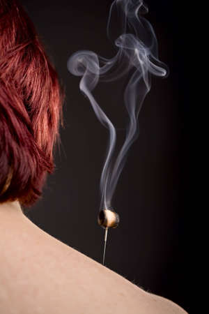 Woman's shoulder with smoking moxa on acupuncture needleの写真素材