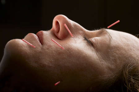 Female acupuncture patient receiving treatment to faceの写真素材