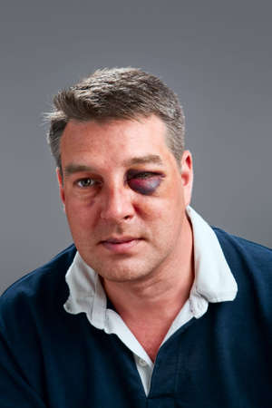 Portrait of a Caucasian male with bruised black eyeの写真素材