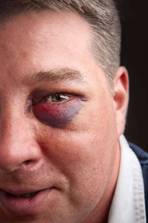 Portrait of a man with a black eyeの写真素材