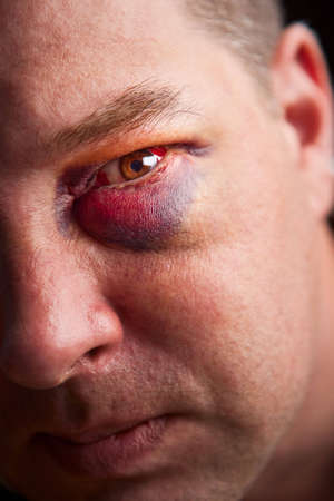 Close-up of man with genuine black eye - focus on eyeの写真素材