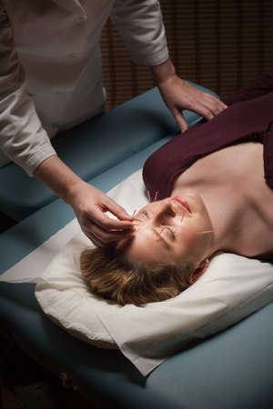 Female acupuncture patient receiving treatment to her faceの写真素材