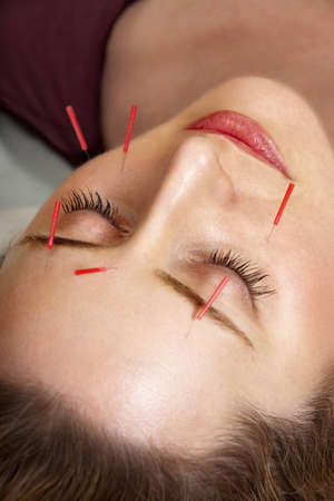 Female patient receiving acupuncture treatment to her faceの写真素材