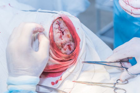 the hands of a surgeon's doctor sewing up the cut of the skin after an operation to remove the atheroma on the patient's head in the hospital. concept photo of professional doctors, painless medicineの写真素材