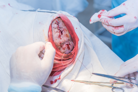 the hands of a surgeon's doctor sewing up the cut of the skin after an operation to remove the atheroma on the patient's head in the hospital. concept photo of professional doctors, painless medicineの写真素材