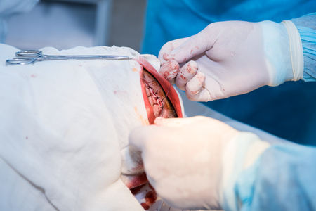 the hands of a surgeon's doctor sewing up the cut of the skin after an operation to remove the atheroma on the patient's head in the hospital. concept photo of professional doctors, painless medicineの写真素材