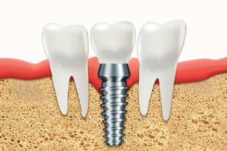 Dental implant, stainless gum post, medical information poster. Teeth replacement concept, dentures,...